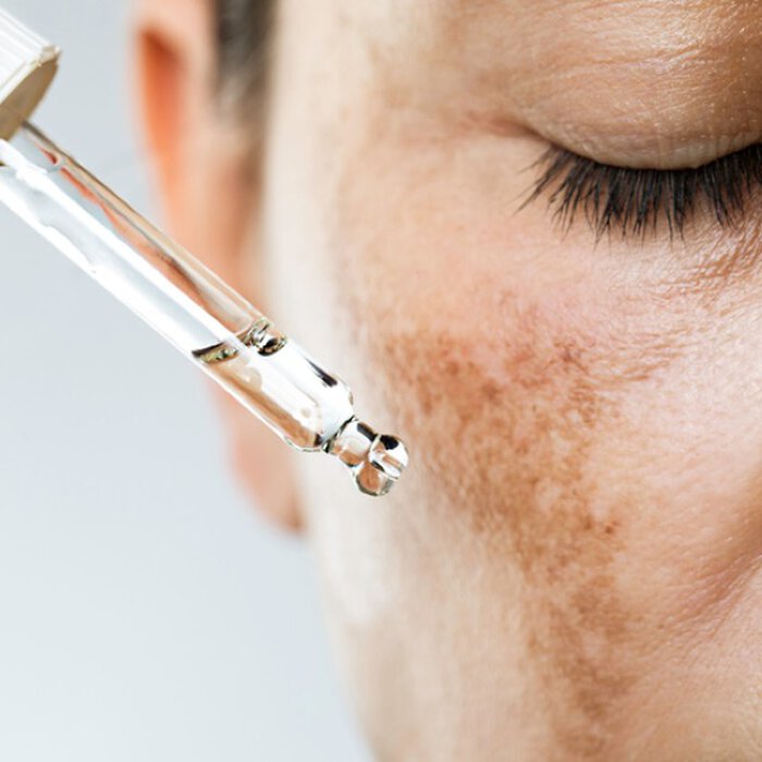 Close-up of a woman's face with a focus on pigment spots