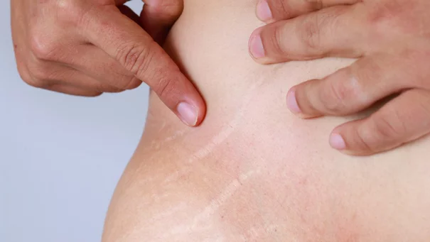 Vergetures sur un homme